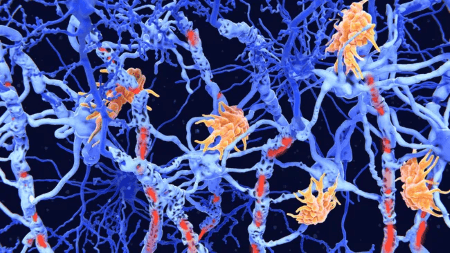 Detecting MS signs before symptoms appear